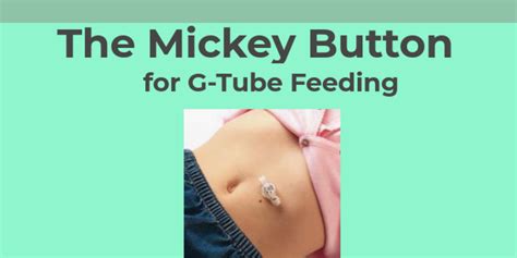 mickey tuber|mickey tube vs peg tube.